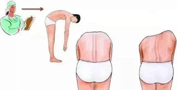 脊柱側(cè)彎篩查后視圖