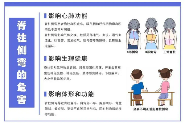 脊柱側彎危害
