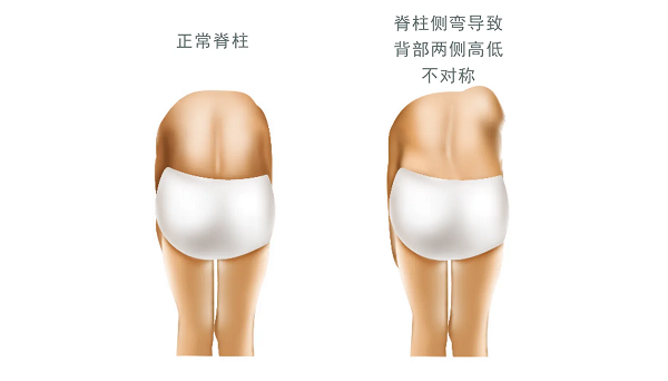 正常脊柱和脊柱側(cè)彎對比圖