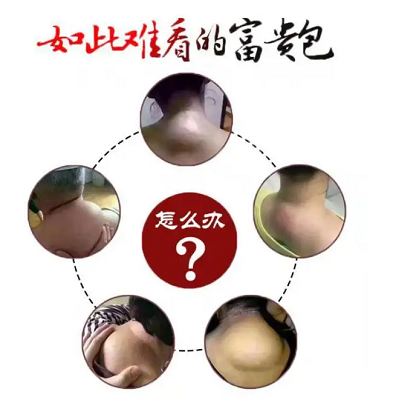 如此難看的富貴包怎么辦？