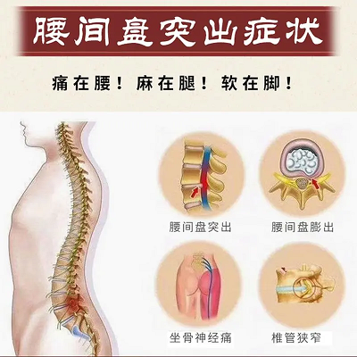 腰椎間盤突出癥狀