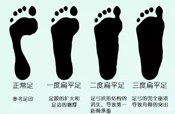 正常足和扁平足對比示意圖