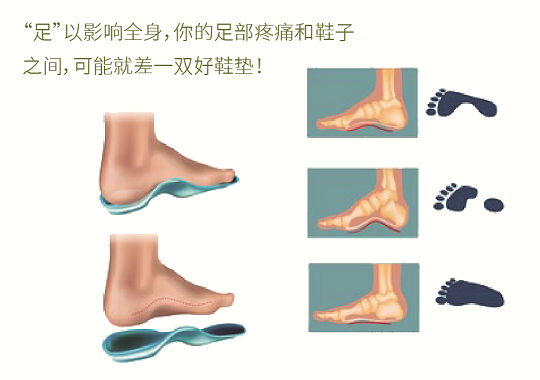 直樂3D打印矯形鞋墊