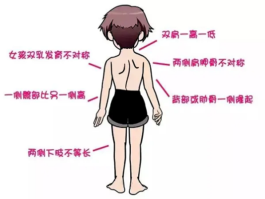 脊柱側(cè)彎體態(tài)特征