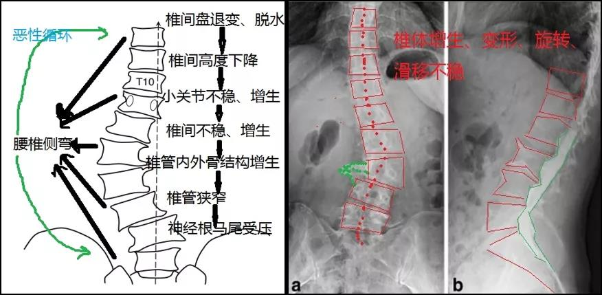 腰椎側彎
