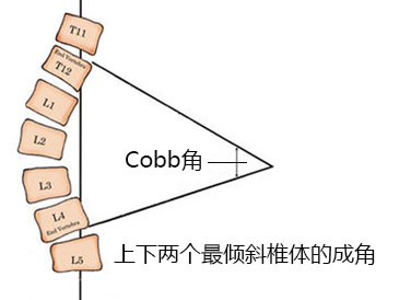 cobb角測量方法