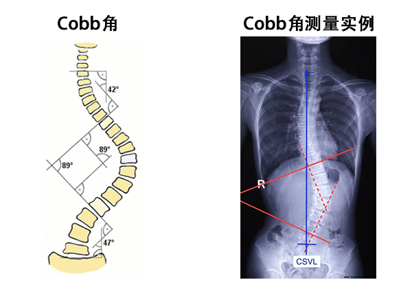 cobb角測量實(shí)例