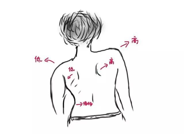 脊柱側(cè)彎外觀特征