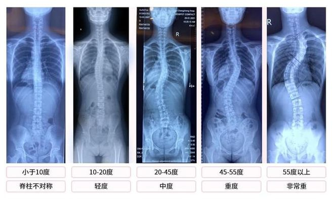 不同階段脊柱側(cè)彎X光片