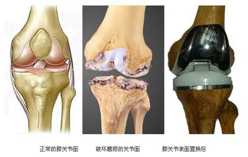 膝關(guān)節(jié)置換