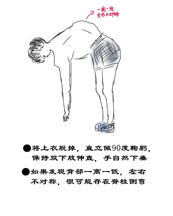 脊柱側(cè)彎自查方法